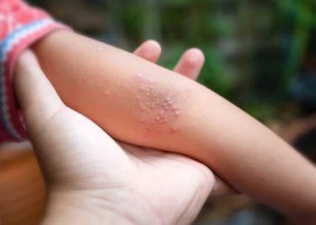 Alerta en Campeche: Virus Coxsackie provoca suspensión de clases por contagio entre niños