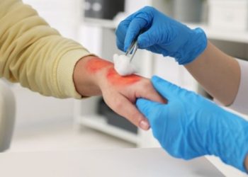 Accidentes por quemaduras dejan secuelas graves y tratamientos de hasta un millón de dólares en México