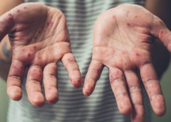 Confirman primera muerte por sarampión en Michoacán en 2026; brote nacional suma más de 7 mil casos