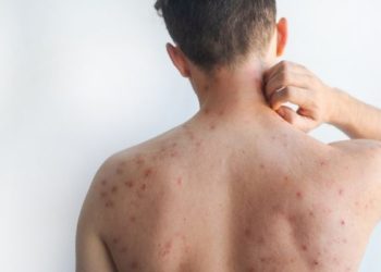 Facultad de Medicina de la UNAM detecta caso sospechoso de sarampión